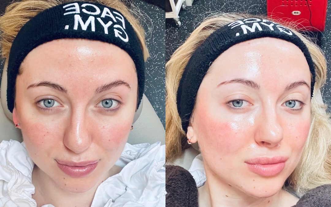 The Facegym medi-lift mask gave me more definition than filler