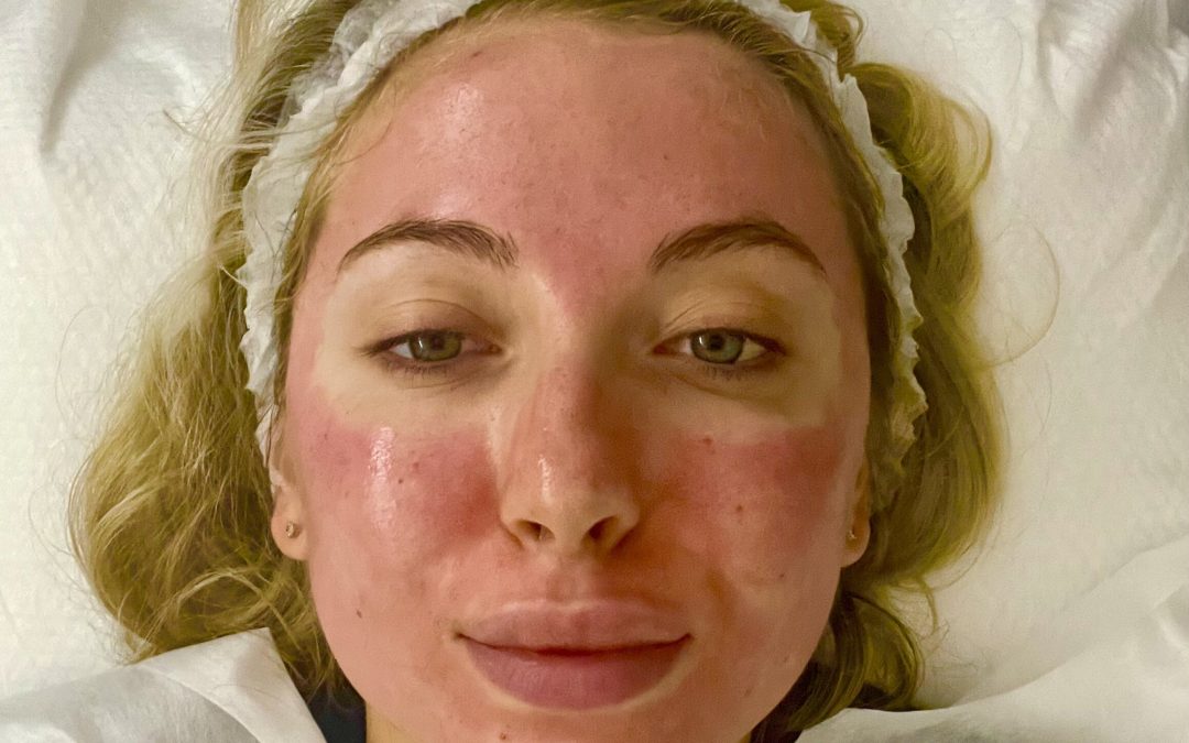 Meet the vampire facial’s little sister – Growth Factor Induced Therapy